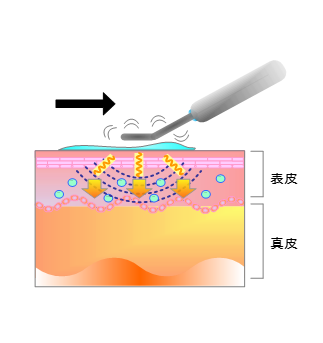キセノン光線治療器「ビオラ V30」